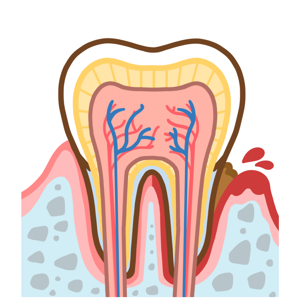 歯の断面図 歯周病