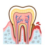 【医療・歯・歯科】歯の断面図　歯周病版のフリーイラスト